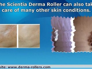 Appendectomy Scar Removal