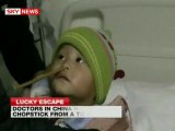 Operato il bambino cinese con le bacchette nel cervello