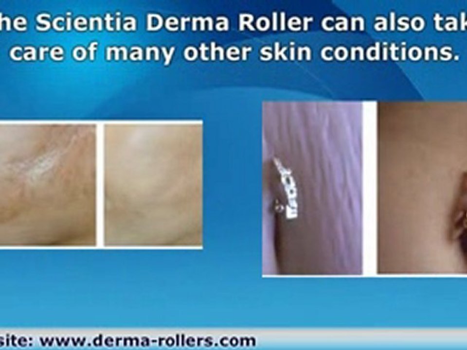 Mesoroller or Meso Roller