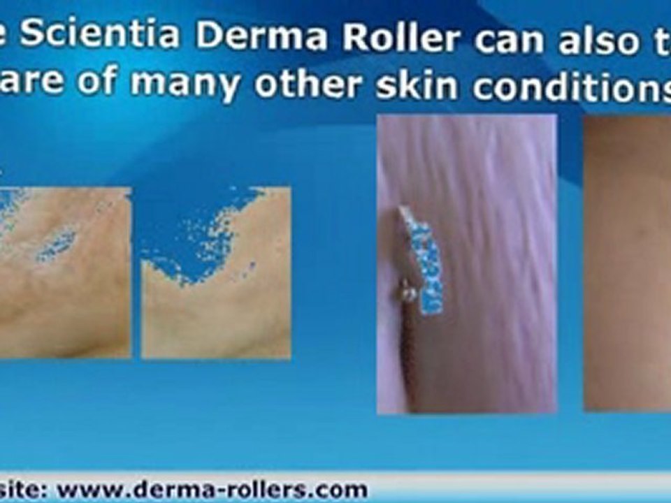 Derma Skin Roller