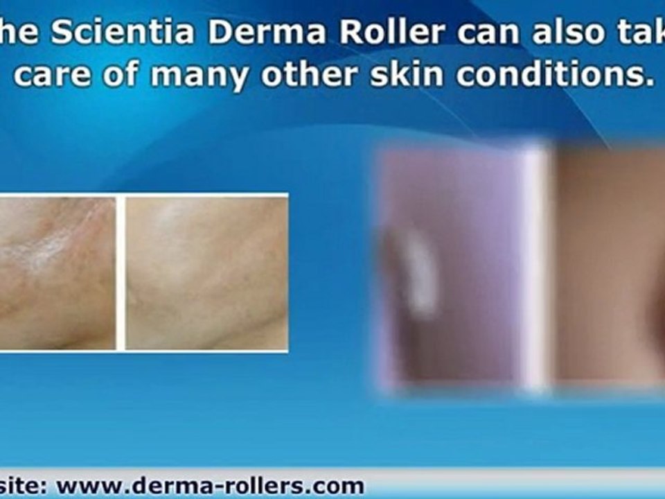 Skin Roller