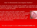 How to cure Angular Cheilitis