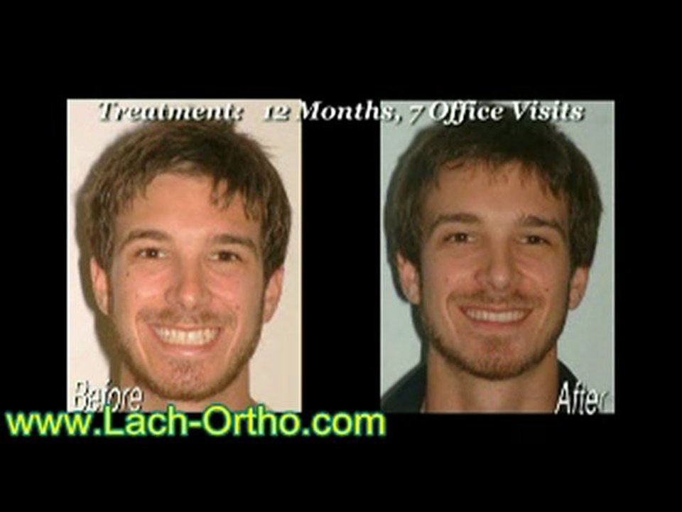 Orlando orthodontist - clear adult braces -invisalign suresm
