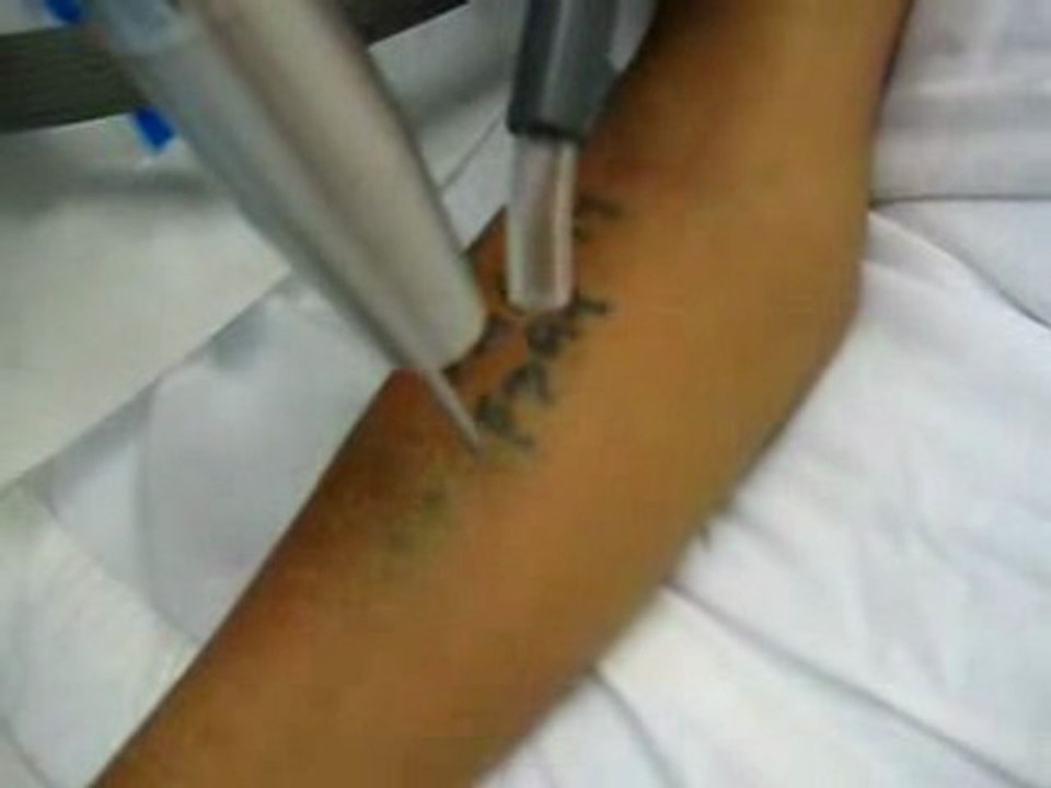 How to remove tattoos