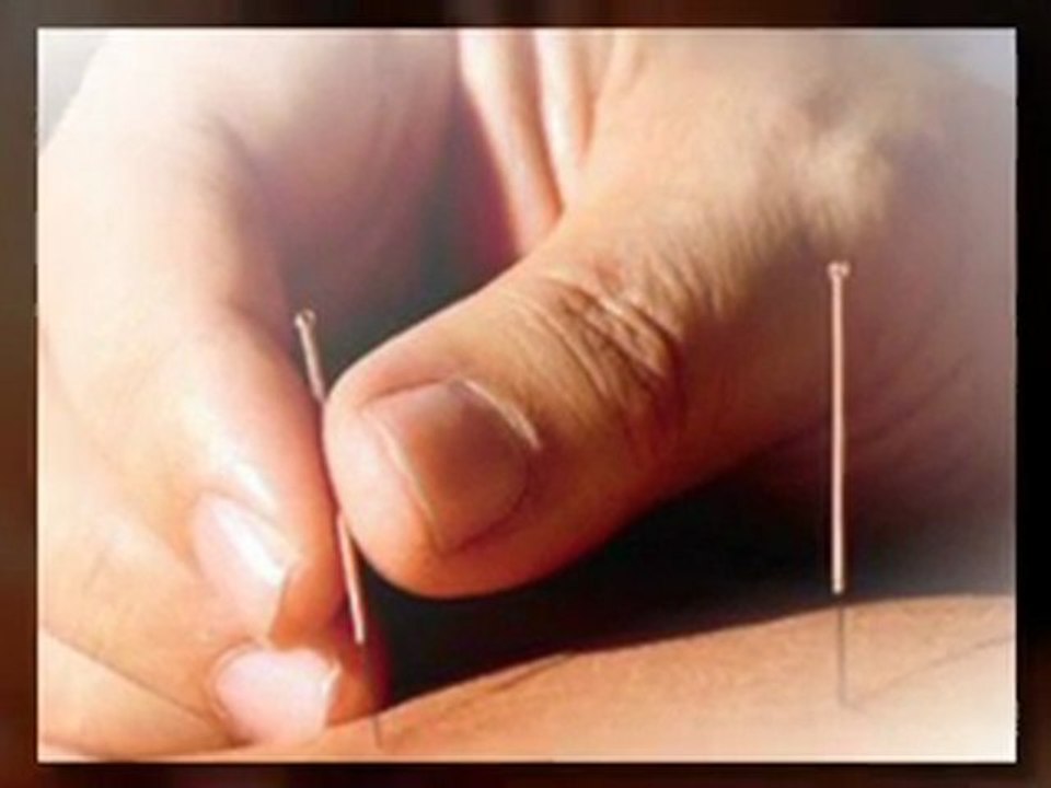 Bethesda Acupuncture