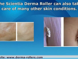 Buy a Derma Roller