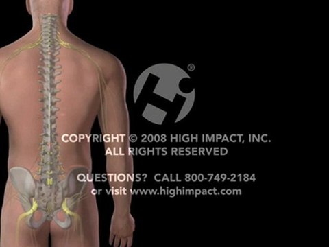 Lumbar Spinal Cord Stimulator Placement