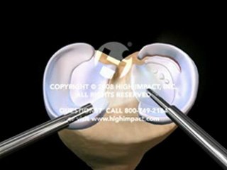 Right Knee Arthroscopy