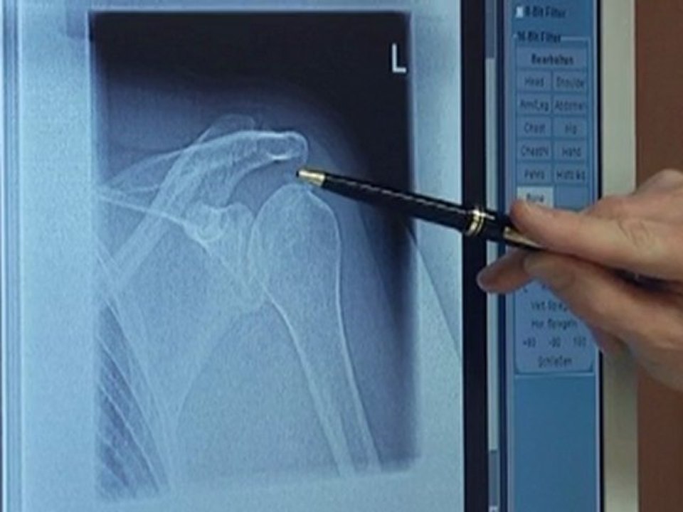 Kalkschulter - fokussierte gezielte stoßwellentherapie,