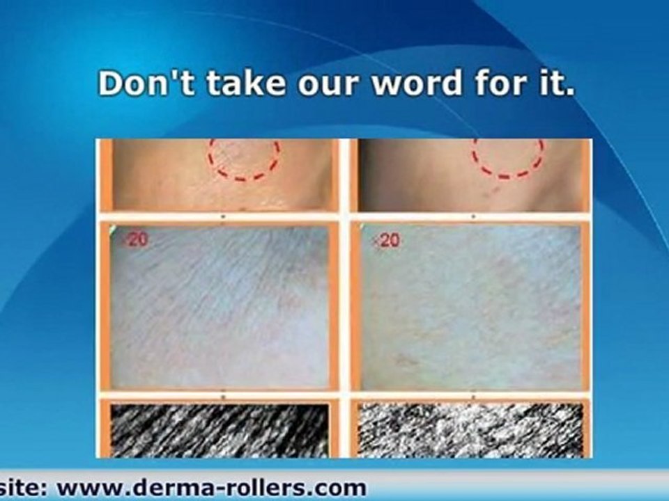 Laser For Skin