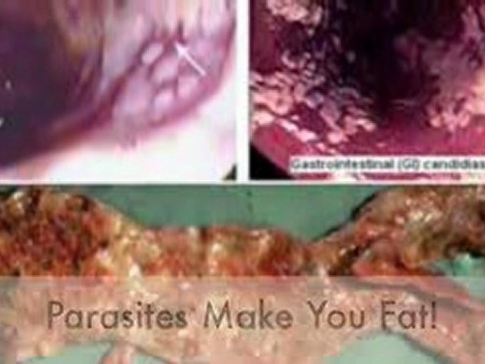 Parasite Detox For Health And Weight Loss