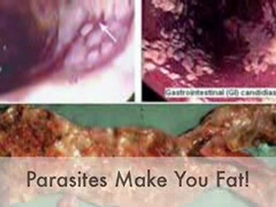 Cleanse Parasite For Health And Weight Loss