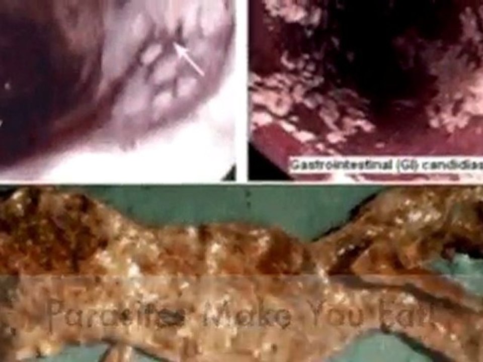 Parasites Cleansing For Health And Weight Loss