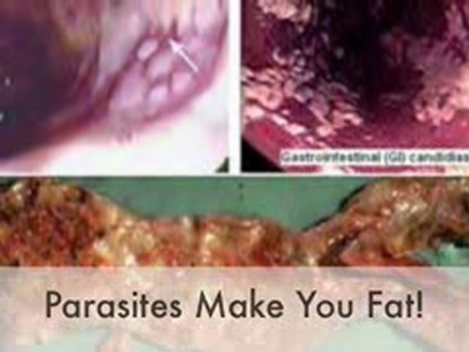 Parasite Cleanse For Health And Weight Loss