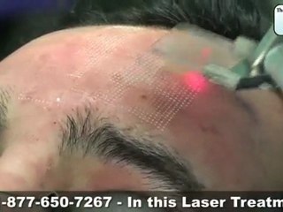FX Laser Treatment