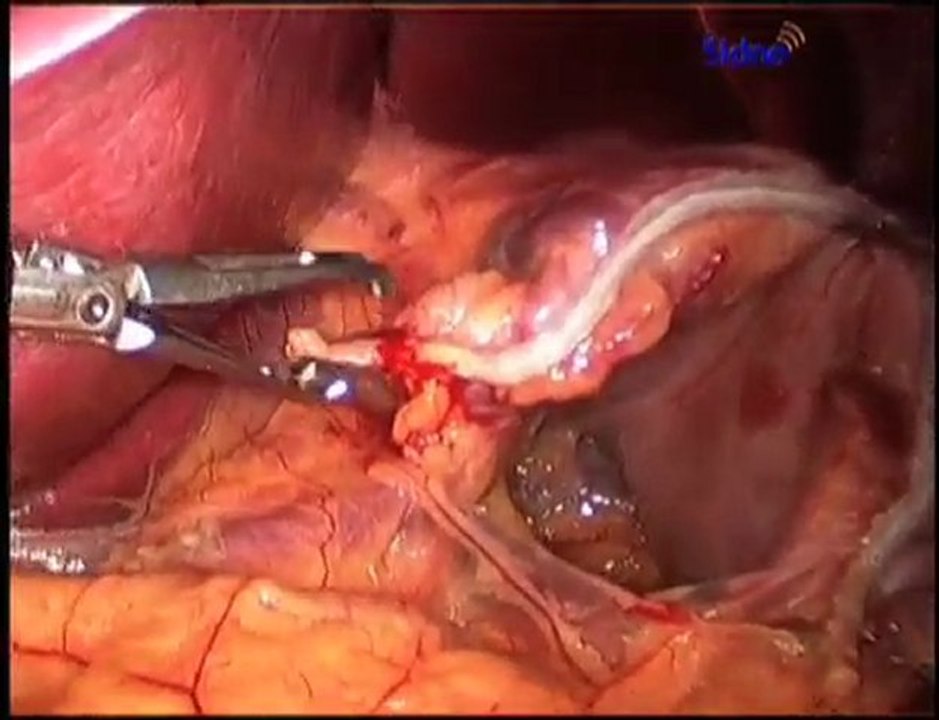 Discover the Leading Gastric Bypass San Antonio Has to Offer