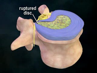 What is a Herniated Disc? - Atlanta Chiro - Gainesville Ga