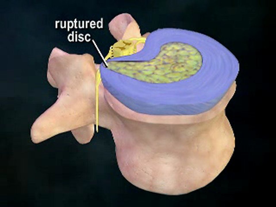 What is a Herniated Disc? - Atlanta Chiro - Gainesville Ga