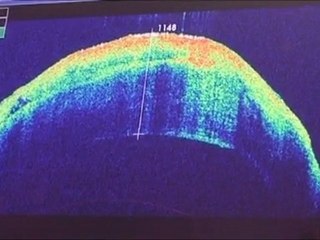 Cornée artificielle : la greffe prend