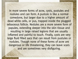 Adult Onset Acne - Some Causes and Solutions