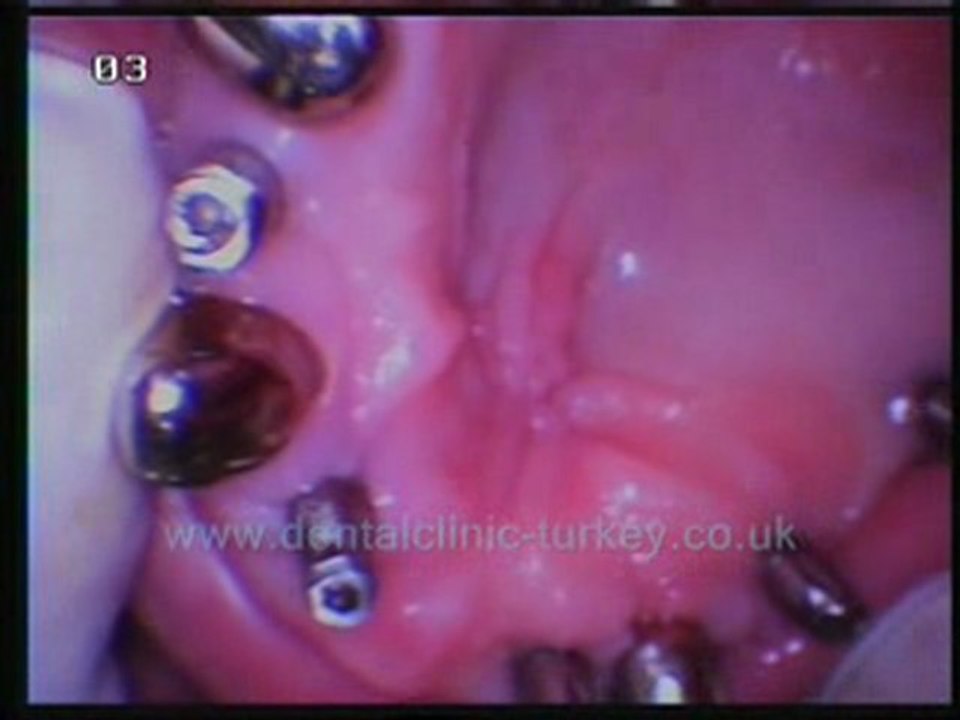 Oktay Firat 12 implants