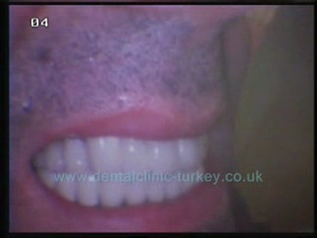 Oktay Firat 28 teeth ceramic prothesis