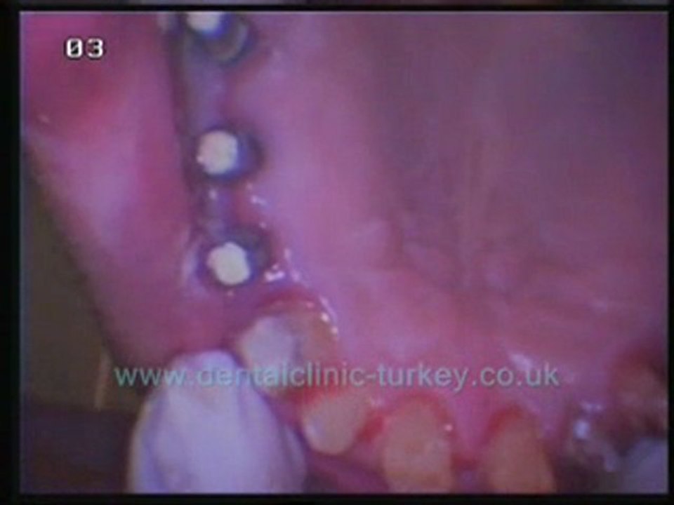Philippe Malbec 12 implants
