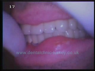 Philippe Malbec 28 teeth ceramic prothesis