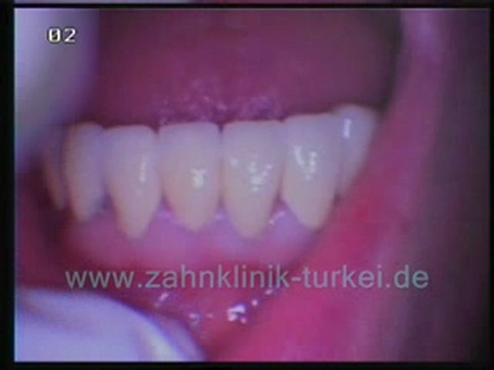 Gigliola Caliz (5 implantate + 18 glied keramik brücke)