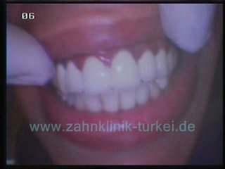 Jeannot Aurelie 21 glied keramik brücke