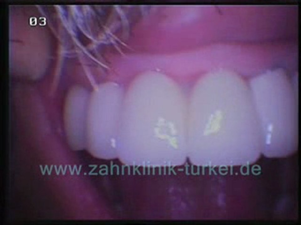 Nazmi Guclu (24 glied keramik brücke befertigung)