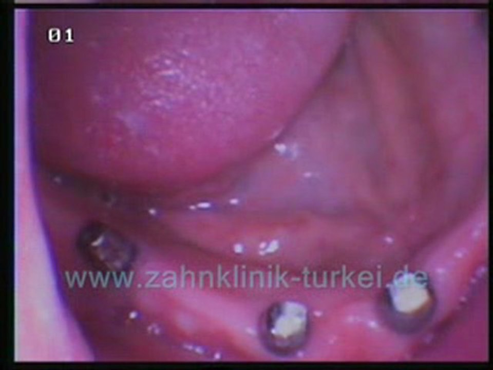 Nazmi Guclu (untere kiefer 6 implantate)