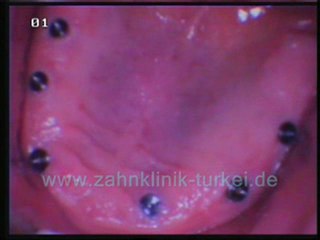 Nazmi Guclu (obere kiefer 6 implant)