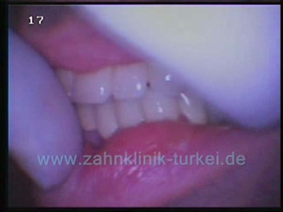 Philippe Malbec (28 glied keramik brücke befertigung)