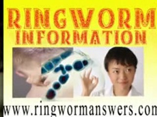 ringworm information