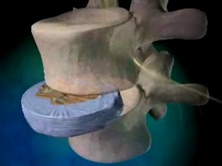 What is Degenerative Disc Disease? - Chiropractor Atlanta Ga