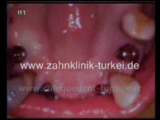 Anette Gotal mâchoire supérieure 6 implants