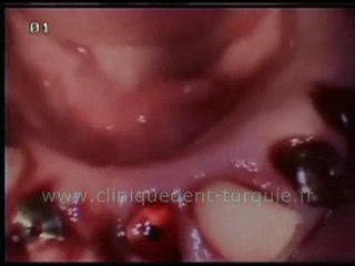 Frank Vorbau mâchoire inférieure 8 implants