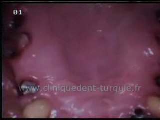 Frank Vorbau mâchoire supérieure 8 implants