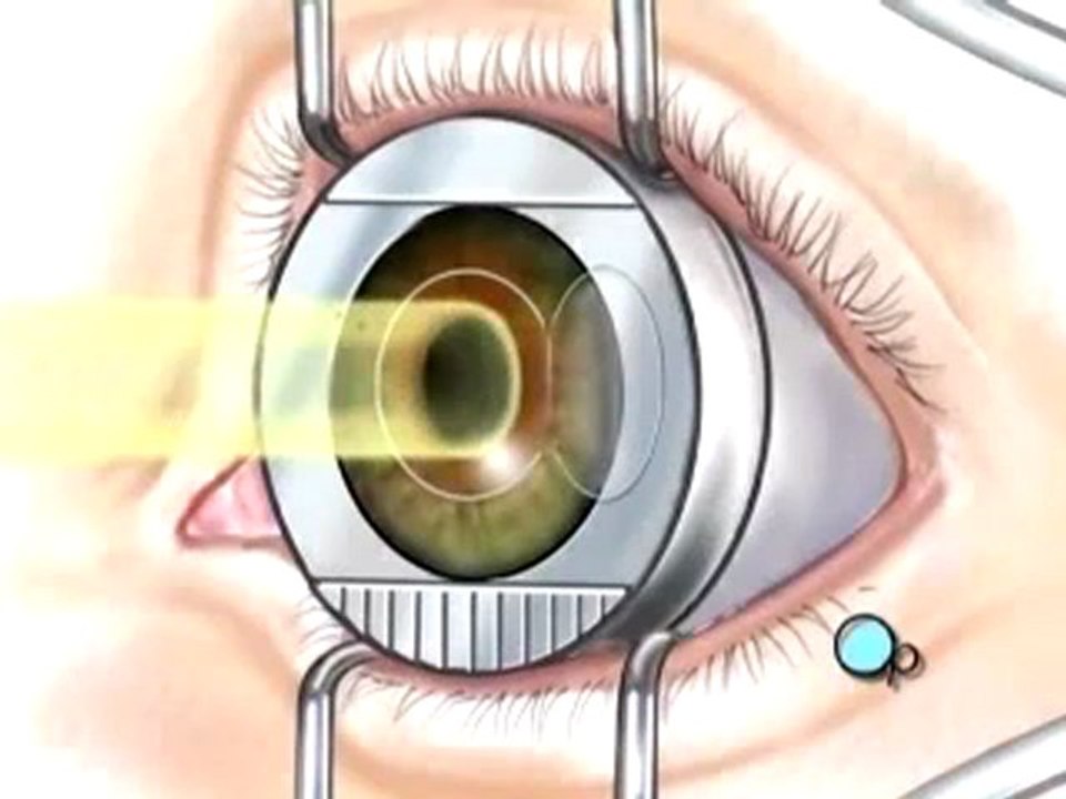California lasik surgery What Is Ophthalmology?
