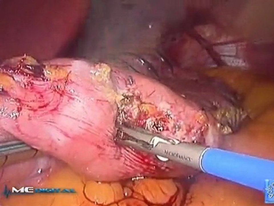 sleeve gastrectomie