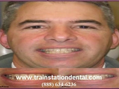 Cherry Hill Straightens Teeth with Invisalign Invisalign in