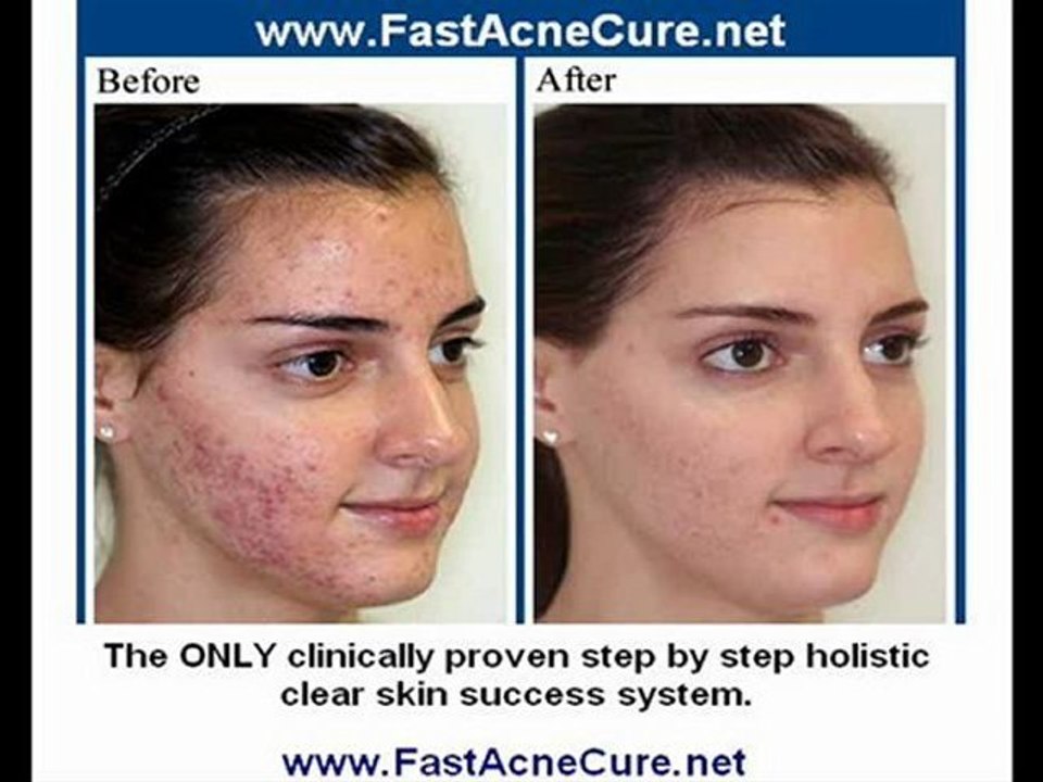 Get Rid Of Pimples & Pimple Scars Remove Face Pimples