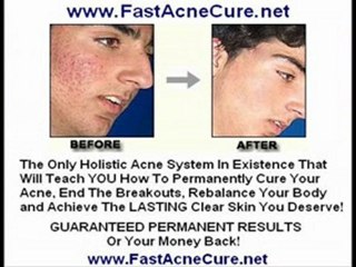 Blemish Treatment - Skin Bleimshes Acne Facial Control