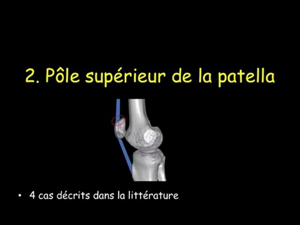 Sleeve fracture