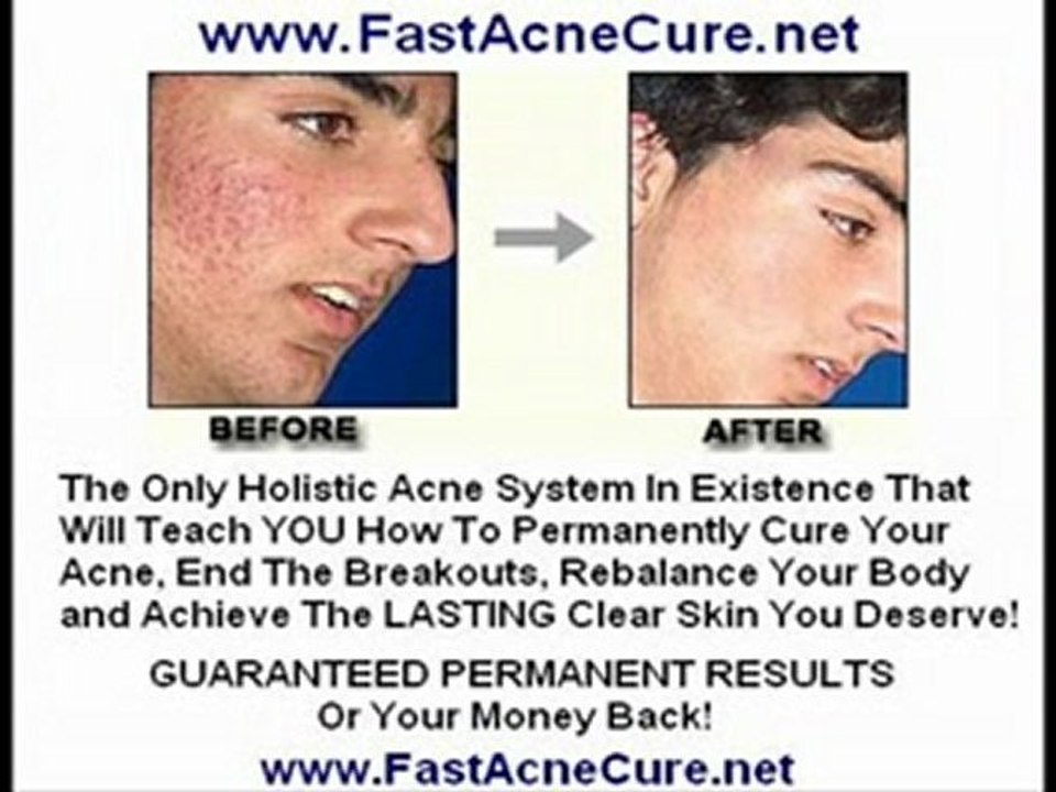 Acne Treatment Adult Acne Back Acne Cystic Acne Products