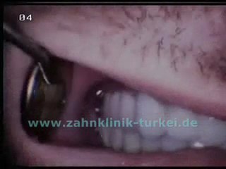 Frank Vorbau (28 Glied Keramik Brücke)