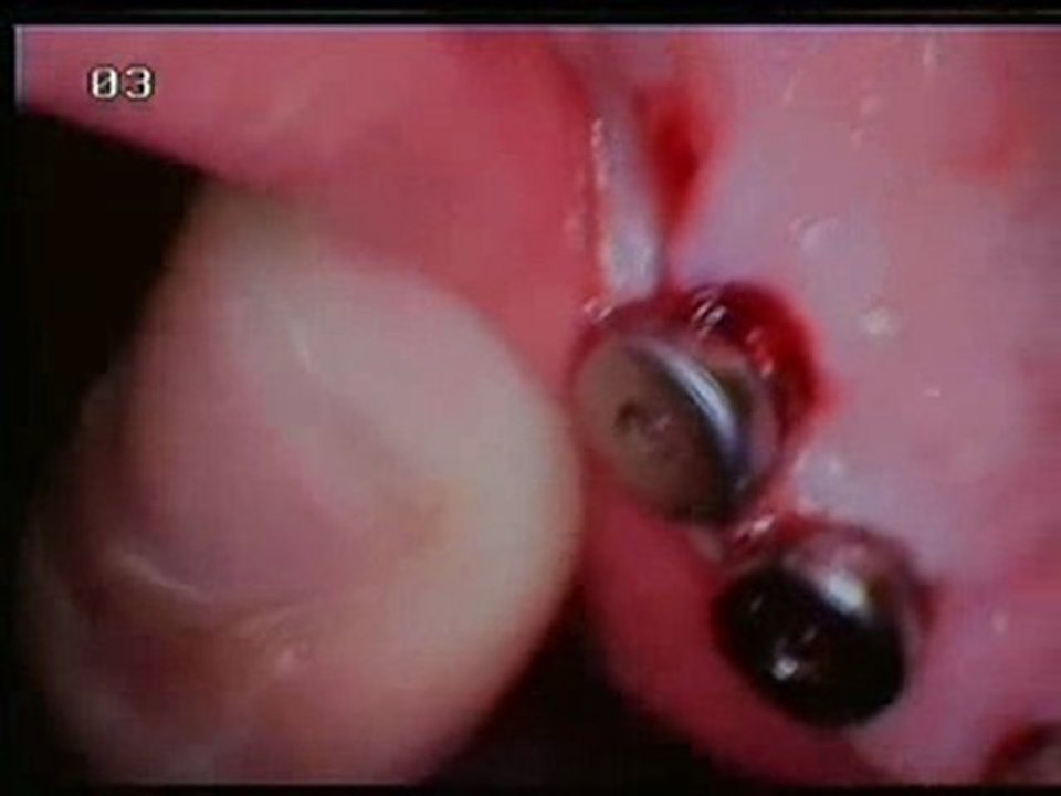 Frau Klohn 8 implantate