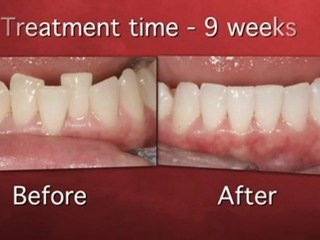 The Inman Aligner™ Bracing System – Red Sky Dental Spa UK