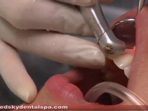 Gum Disease Treatment Doncaster UK – Red Sky Dental Spa